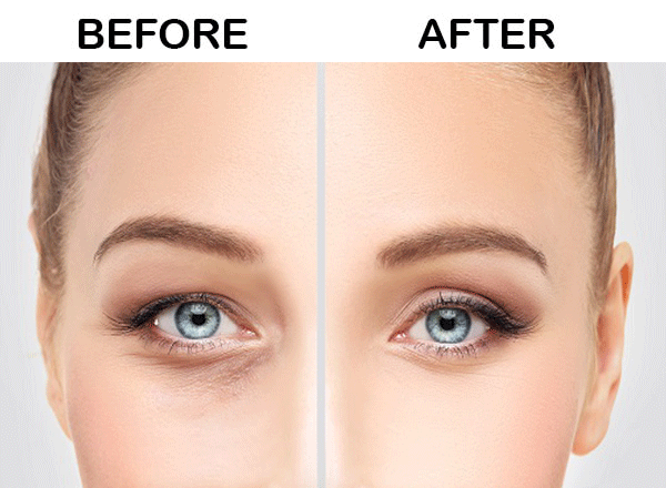 Eyelid Surgeries2.png